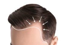Der Unterschied zwischen einer Haartransplantation und einem Haarimplantat